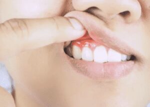 Person lifting lips to expose red inflamed gums gum disease dentist in Ardmore Pennsylvania