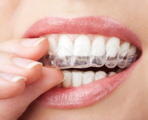 close up of patient putting clear plastic aligners on their teeth Invisalign cosmetic dentistry dentist in Ardmore Pennsylvania